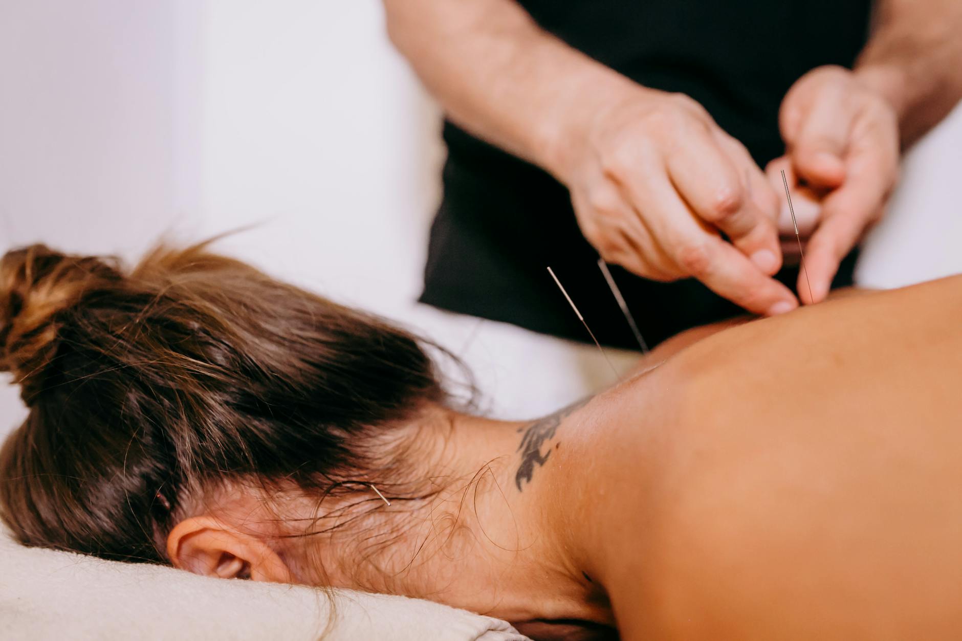 hands inserting needles on the person s back